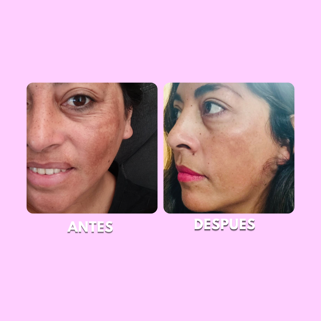 Pack Despigmentante - Retinol y Vitamina C