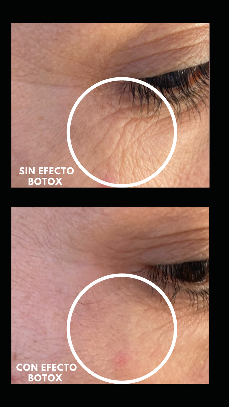 Pack Efecto Botox - Tratamiento para líneas de expresión