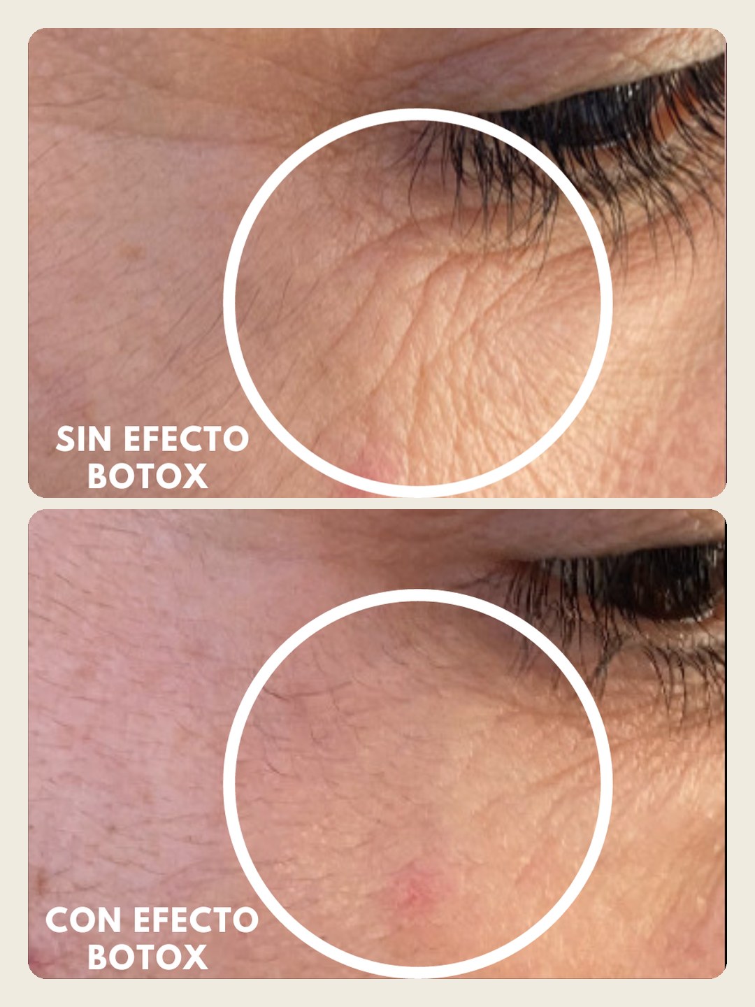 Antes y después de una clienta: contorno de ojos sin y con el Pack Efecto Botox