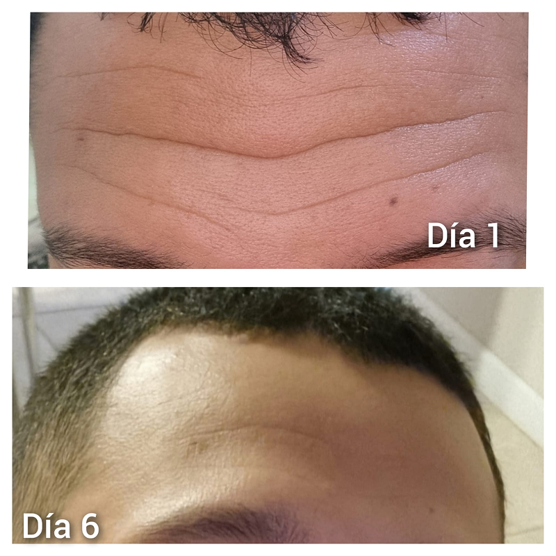 Booster Efecto Botox - ARG-AH
